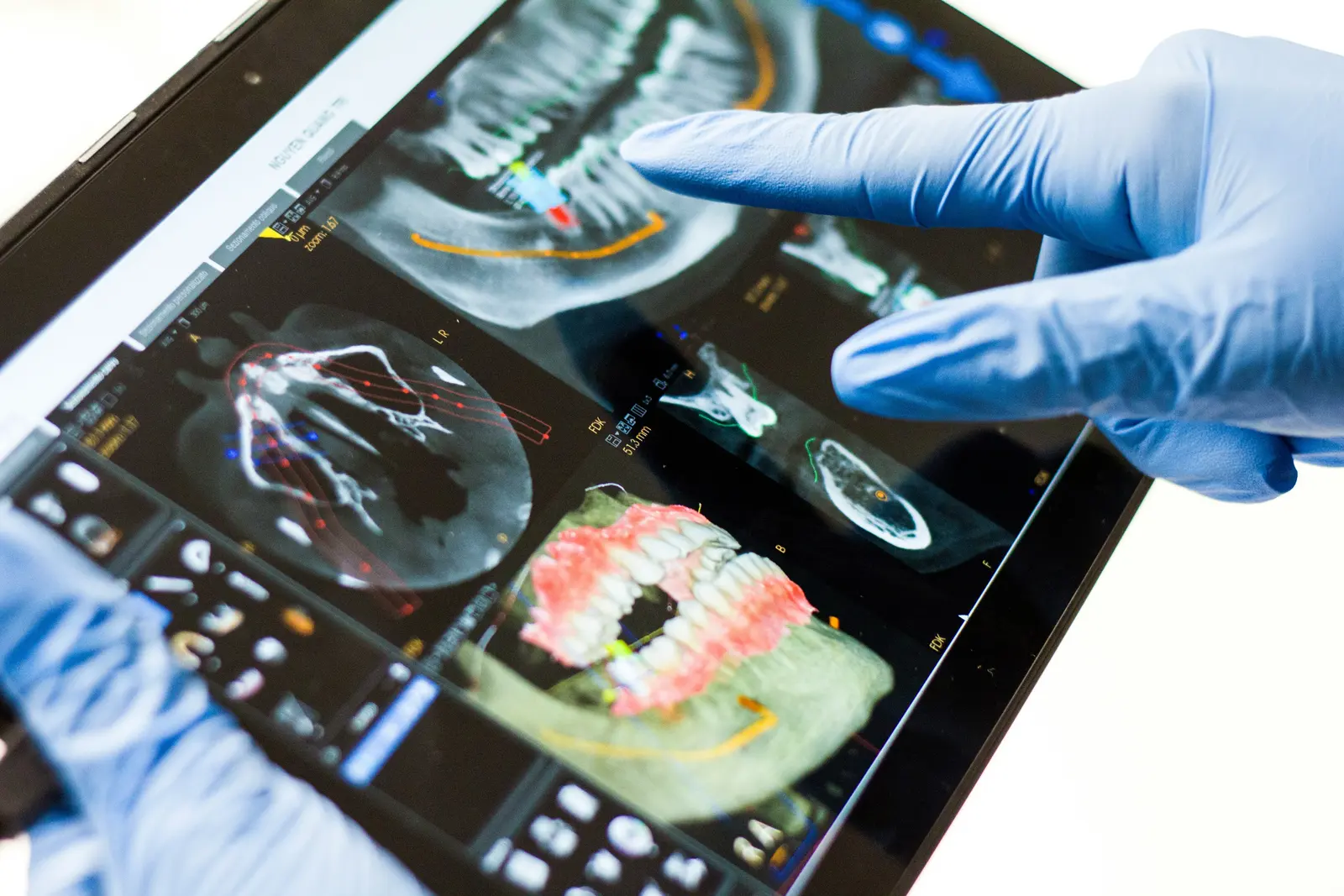 Single Tooth Implant Cost in Victoria: What Affects Your Quote