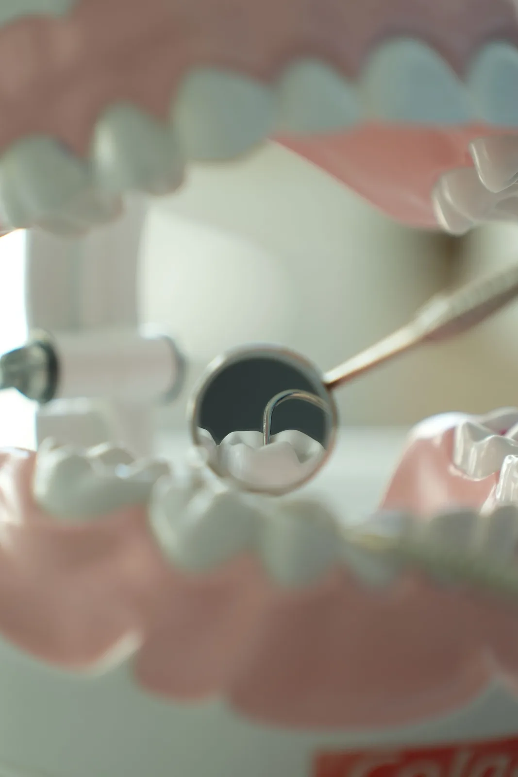Dental mirror view inside the mouth, referred to in the Bone Grafting section for Victoria