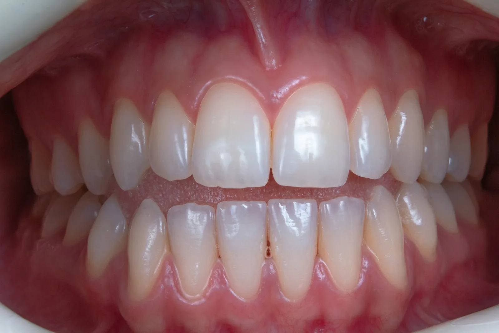 Full arch intraoral view of the teeth, shown while covering Implant Financing in Victoria