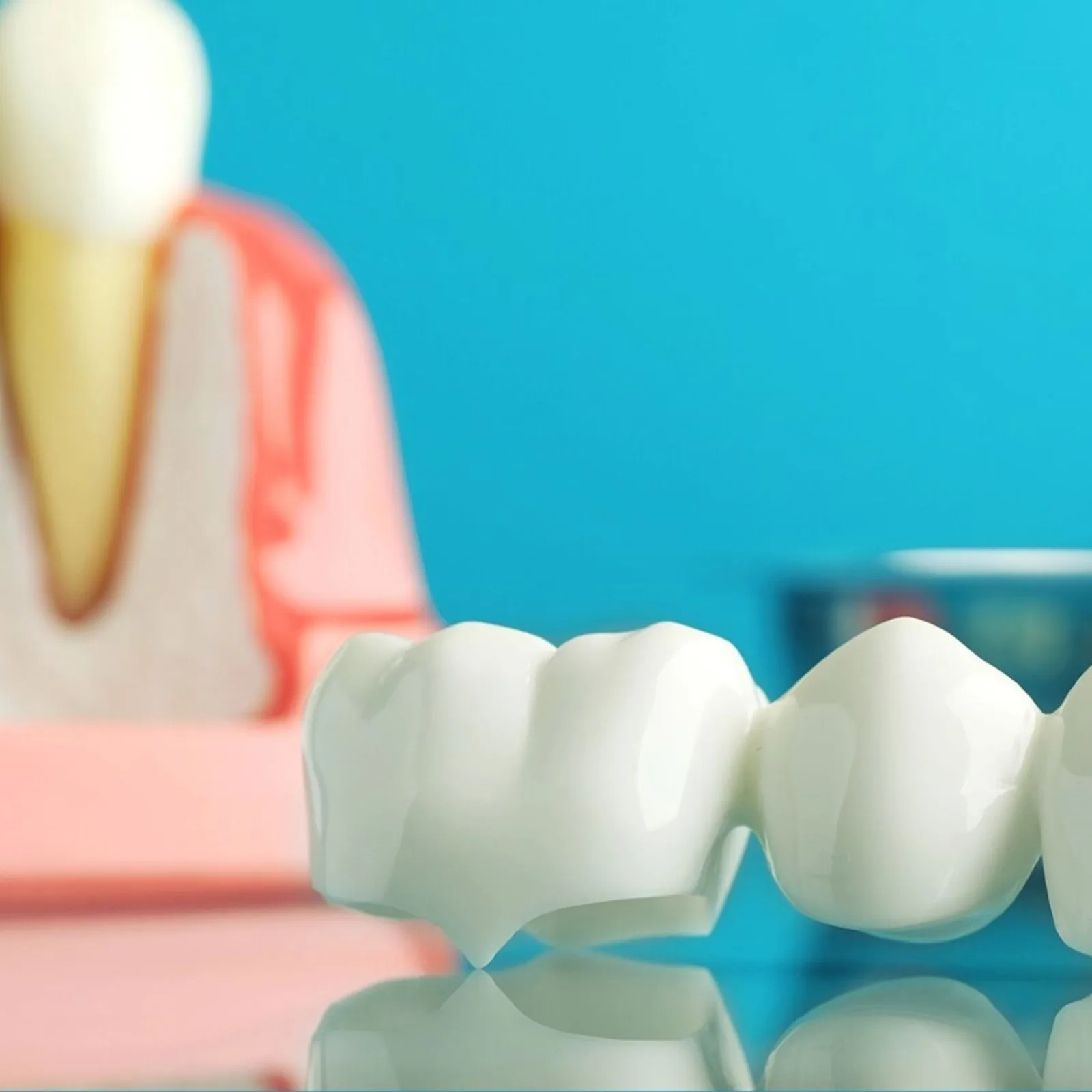 Implant and crown model on display, alongside the CBCT Imaging explanation in Victoria