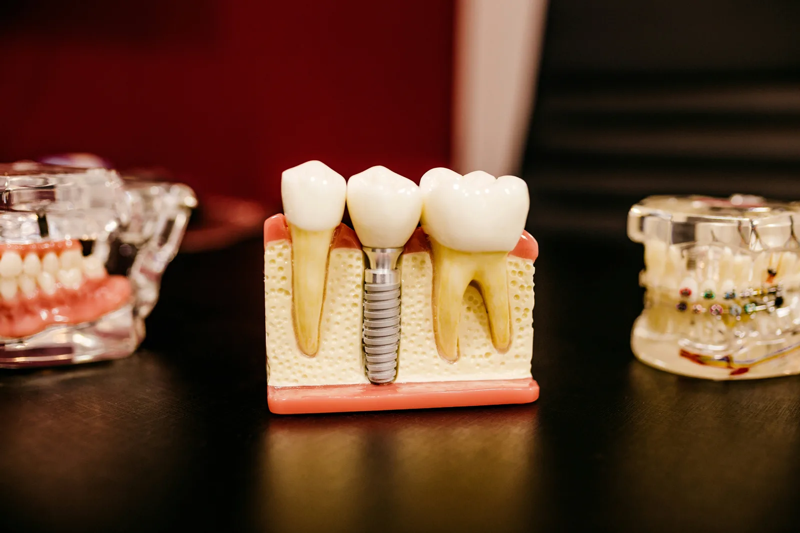 Cross-section model showing an implant in the jawbone, shown while covering dental implant treatment in Victoria