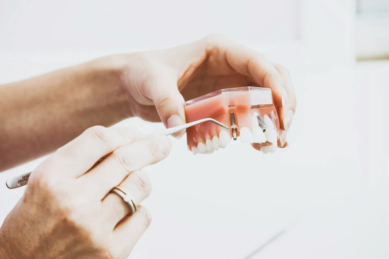 Implant model examined with a dental probe, shown while covering Guided Implant Surgery in Victoria