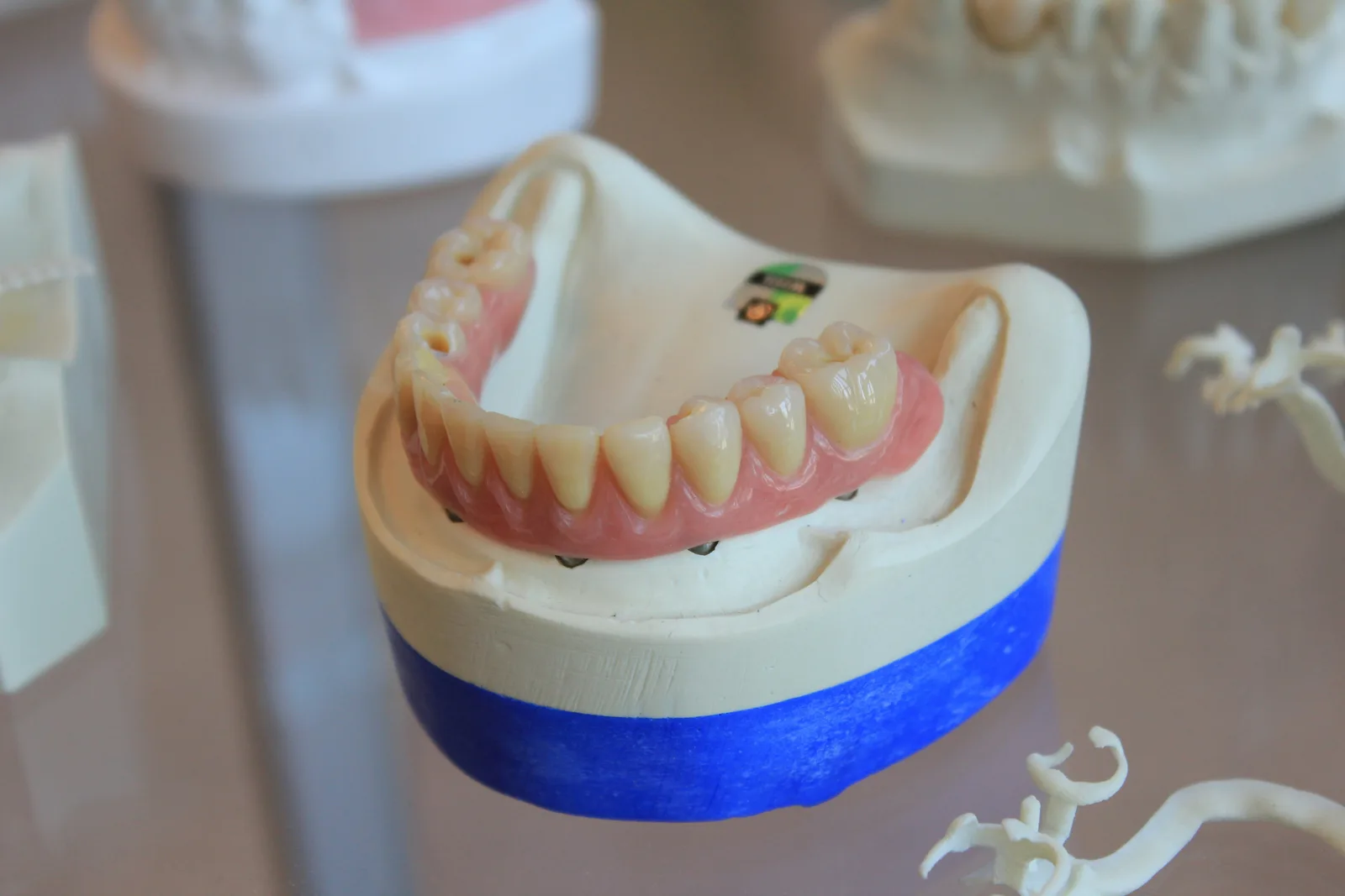 Implant supported denture on a study model, referred to in the Implant Crown section for Victoria