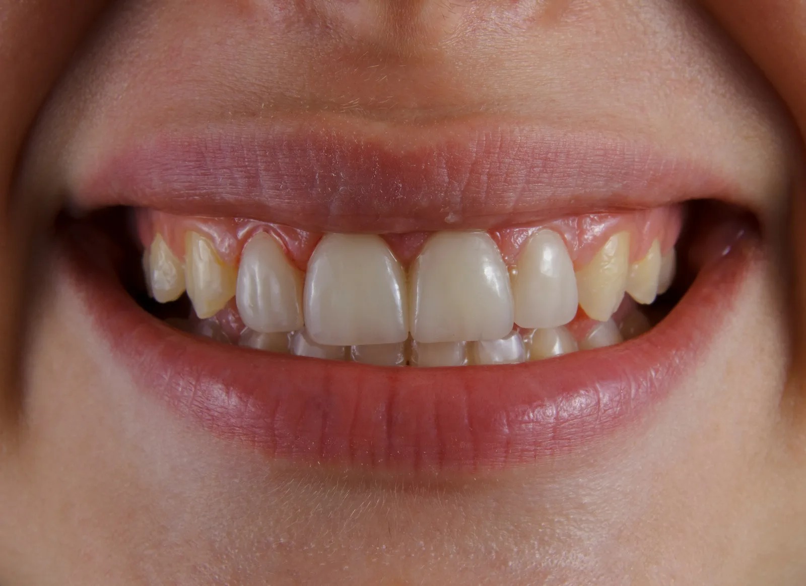 Close-up of a natural smile, referred to in the Guided Implant Surgery section for Victoria