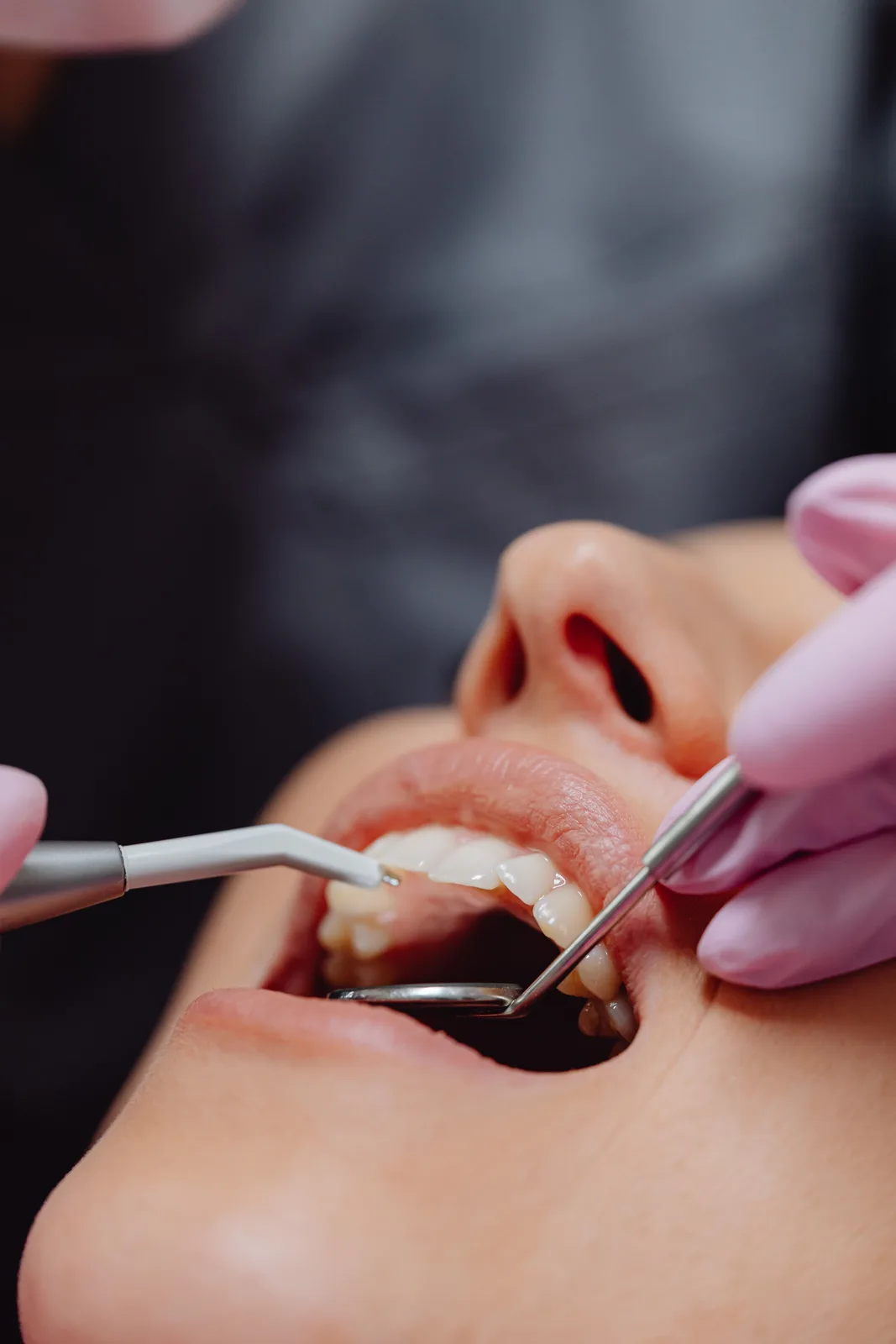 Polishing the teeth after treatment, shown while covering Tooth Extraction Implant in Victoria