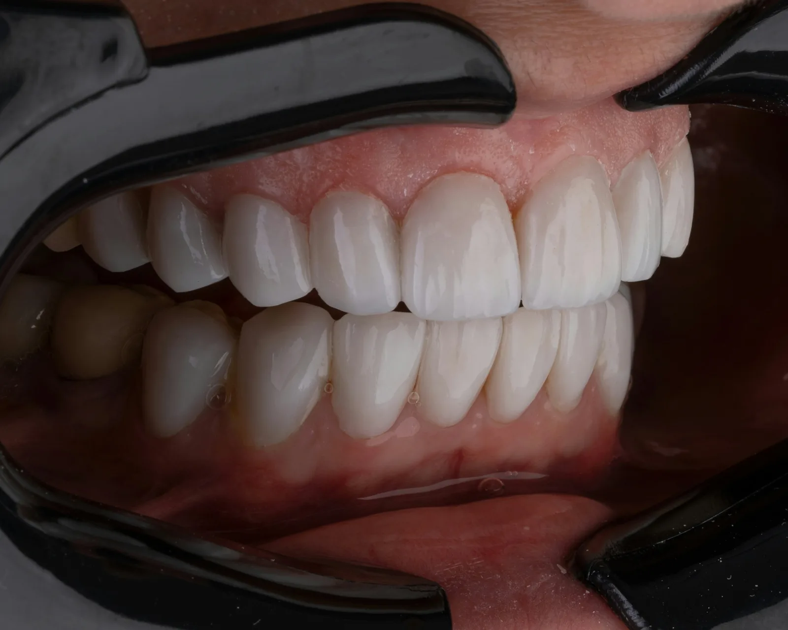 Intraoral view of several restored teeth in one arch, after multiple tooth implants in Victoria