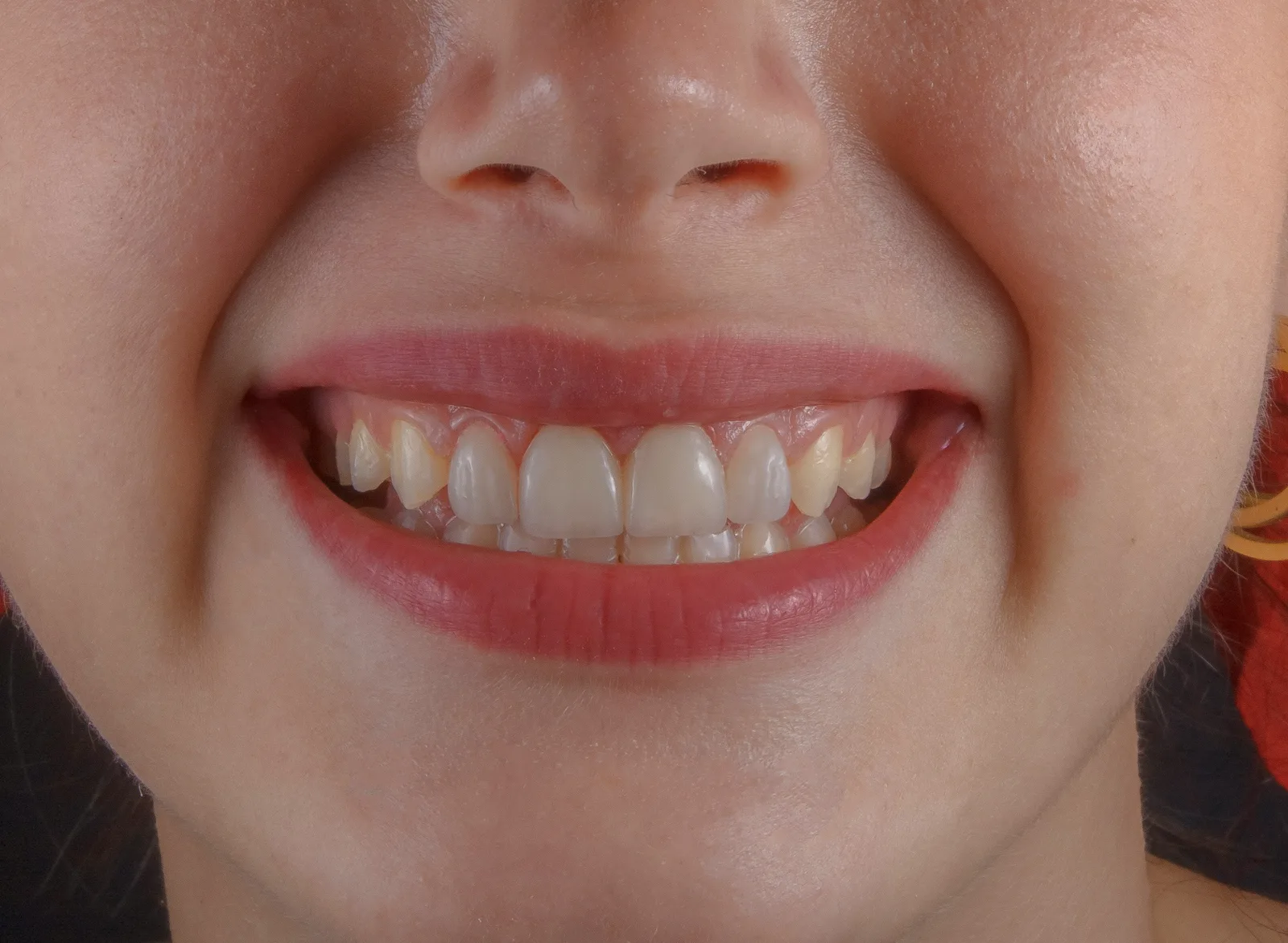 Close-up of a smile before treatment, shown while covering Implant Consultation in Victoria