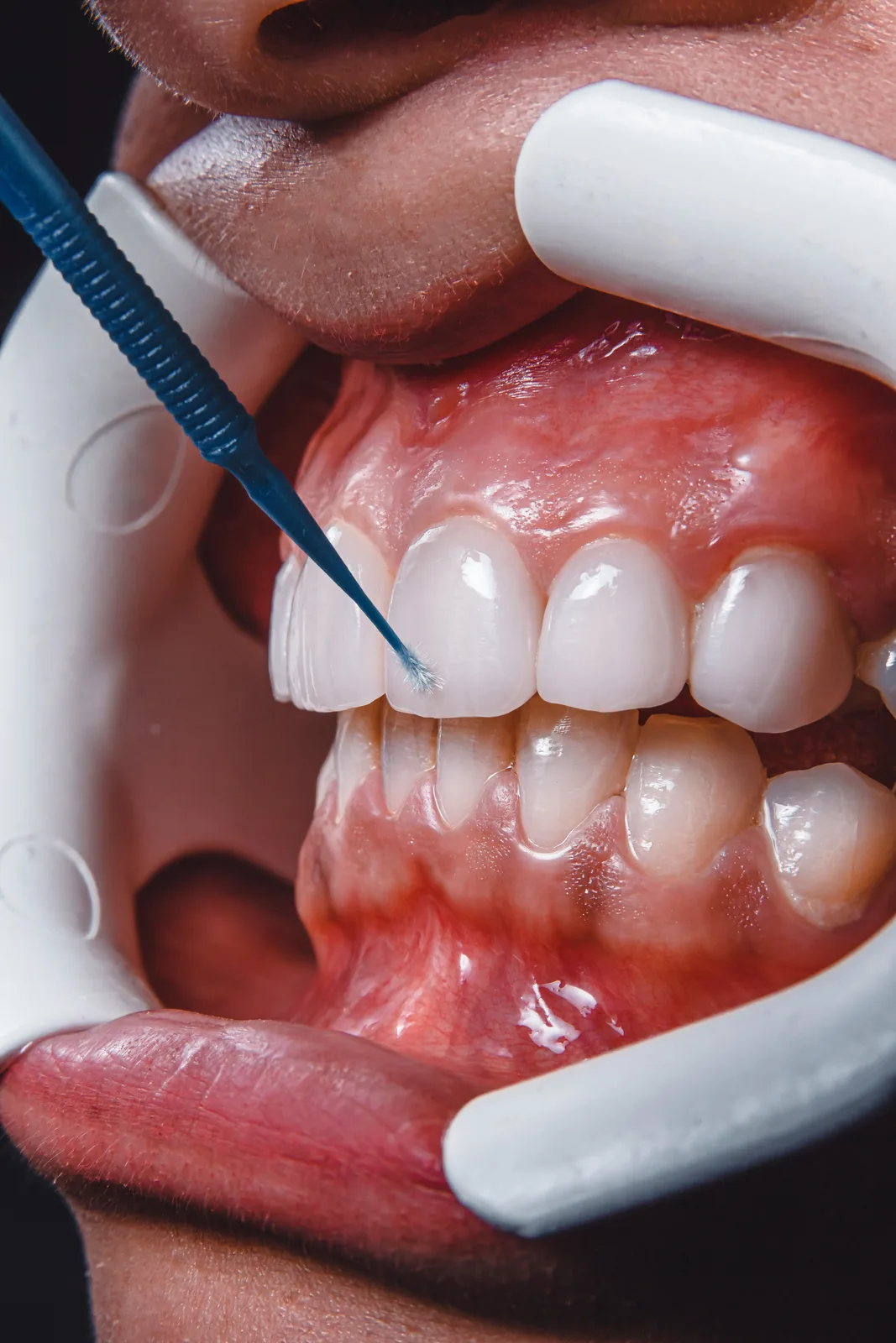 Tooth preparation with cheek retractors in place, alongside the Guided Implant Surgery explanation in Victoria
