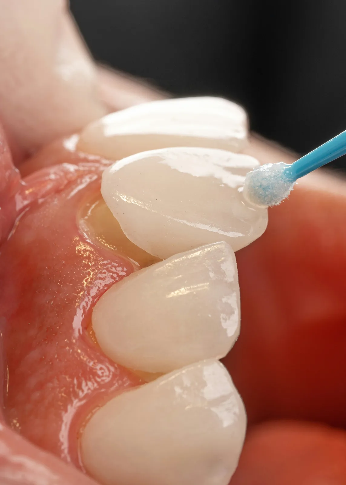Close-up of tooth surface preparation, referred to in the What Are Dental Implants section for Victoria